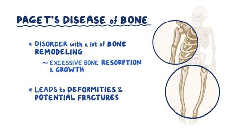 File:Man With Osteitis Deformans, Standing, Side View, 47% OFF