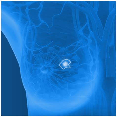 ICAD Profound AI For Digital Breast Tomosynthesis