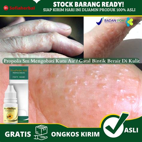 Obat Oles Kutu Air Di Jari Tangan Dan Kaki Obat Gatal Berair Di Jari