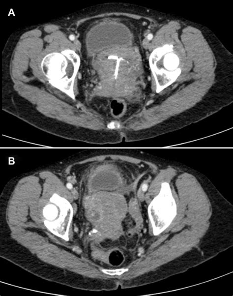 Abdominal computed tomography scan showing peritoneal effusion and ...