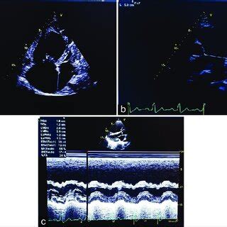 A Two Dimensional Trans Thoracic Echocardiography Performed