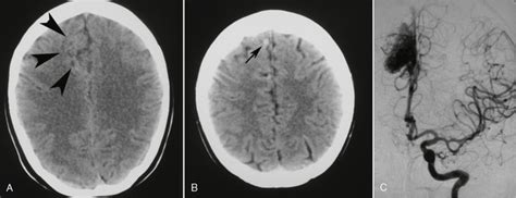 Vascular Malformations Radiology Key