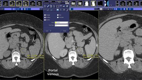 How To Read An Adrenal Protocol CT Scan Adrenal Washout YouTube