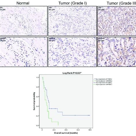 Psmc2 Was Upregulated In Gbc Tissues And Predicted Poor Prognosis A