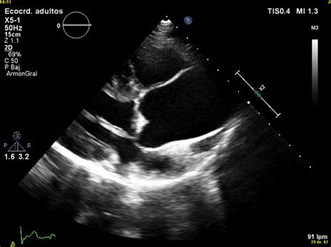 Transthoracic Echocardiogram Dilatation Of Tubular Ascending Aorta Download Scientific Diagram