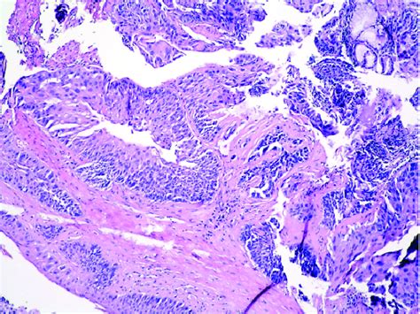 HE 100X Bronchial Wall With Severe Dysplasia And Carcinoma In Situ