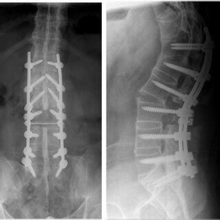 The Conventional X Rays Of The Lumbar Spine After The First Operation