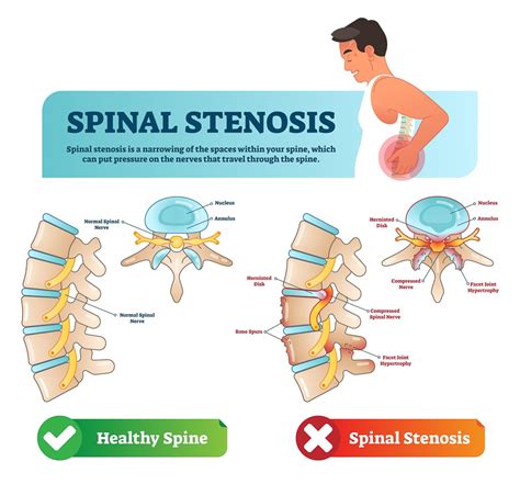 Printable Spinal Stenosis Exercises Pdf Physio Ed