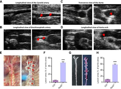 Atherosclerotic Plaque Model A Longitudinal View Of Carotid Artery