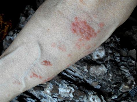 How To Identify 9 Common Skin Rashes Shingles Rash Skin Rashes | Images ...