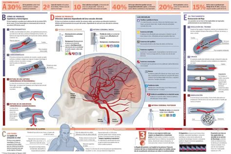 El Infarto Cerebral Y El Estilo De Vida Saludable Por Qu Ocurre