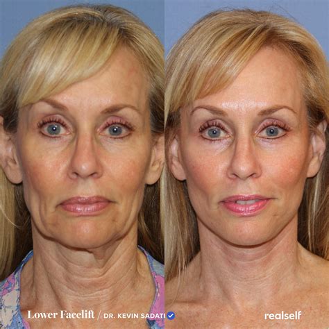 Lower Facelift Vs Neck Lift Whats The Difference In 2024 Lower