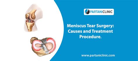 Meniscus Tear Surgery Causes And Treatment Procedure Dr Arun Partani