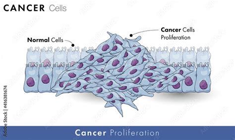 Cancer cell proliferation in healthy tissue or healthy cells with ...