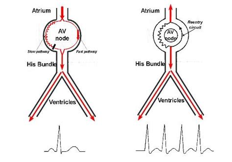 Treatment For AV Nodal Reentrant Tachycardia AVNRT In Washington DC