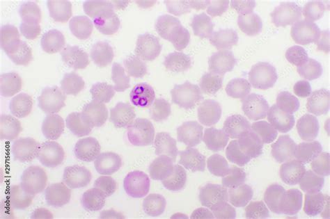 Plasmodium Falciparum Ring