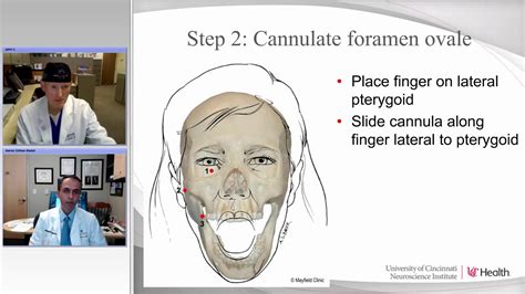 Percutaneous Procedures For Trigeminal Neuralgia Radiofrequency And