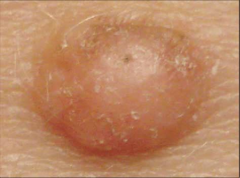 Dermal Nevus