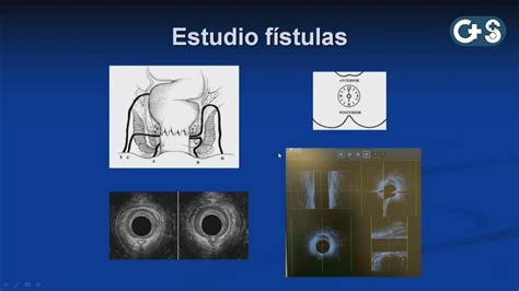 Sesión clínica Ecografía y Manometría Anal Indicaciones y resultados