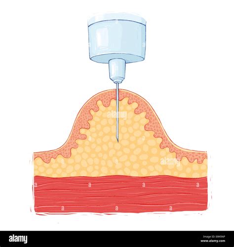 Insulin Subcutaneous Injection