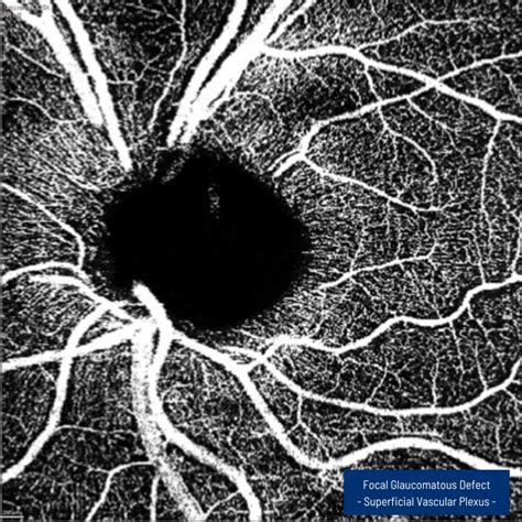 Heidelberg Spectralis Oct Angiography Module Innova