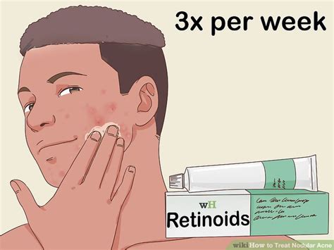 How To Treat Nodular Acne 12 Steps With Pictures Wikihow