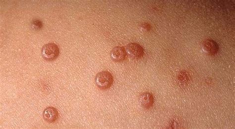 Molluscum Contagiosum Genital Acne That Is Very Contagious World Today News