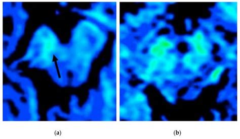 Brain Sciences Free Full Text Imaging Of Substantia Nigra In Parkinsons Disease A