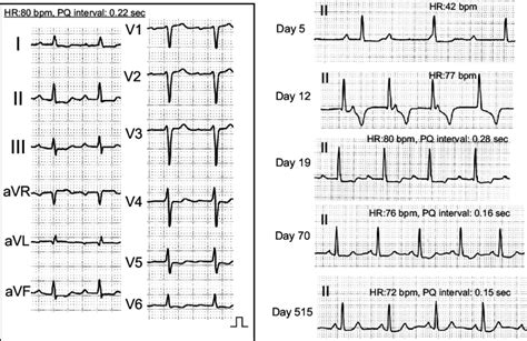 Figure1results Of A 12 Lead Electrocardiogram On Admission A And The Download Scientific