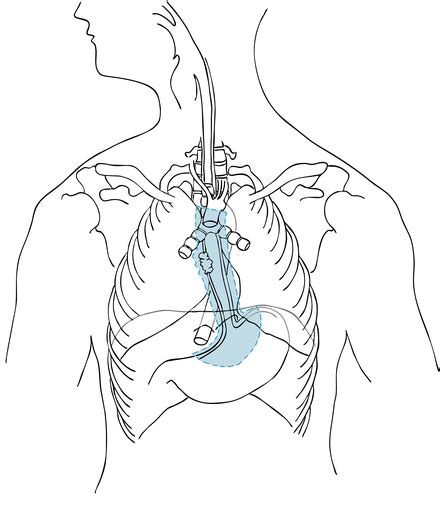 Open Technique For Ivor Lewis Esophagectomy Springerlink