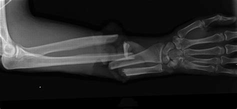 Radius And Ulnar Shaft Fractures Trauma Orthobullets