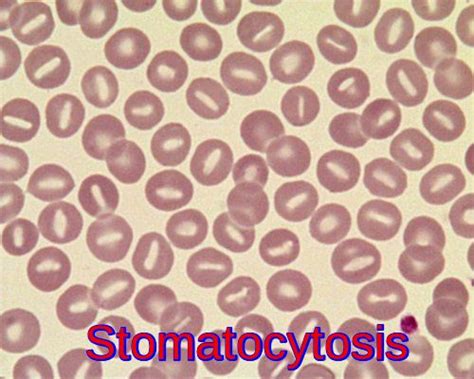 Cold Agglutinin Disease Ask Hematologist Understand Hematology