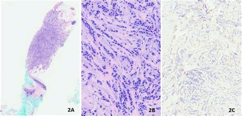 Biopsy Showing Invasive Lobular Carcinoma A Hande B 4x C 40x E Download Scientific Diagram