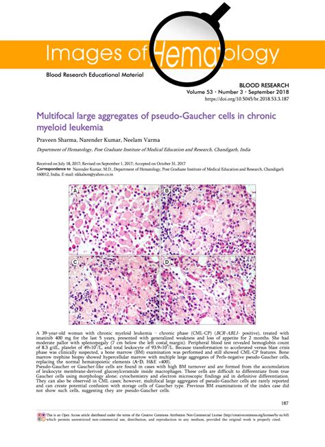 Pdf Multifocal Large Aggregates Of Pseudo Gaucher Cells In Chronic