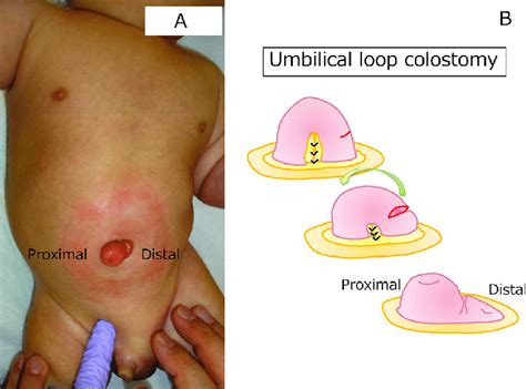 Understanding Stomas Colostomy Ileostomy Urostomy And 58 Off