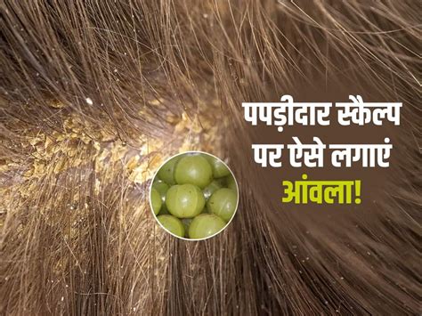 How To Use Amla For Dandruff बालों के साथ पपड़ी भी छड़ रही है स्कैल्प पर लगाएं आंवले के साथ