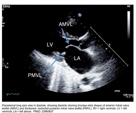 Valvular Emergencies Diagnosis And Management Of Severe Mitral