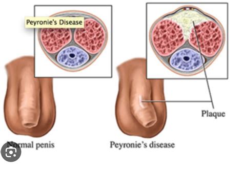 Pathology Penile Diseases Kembara Xtra