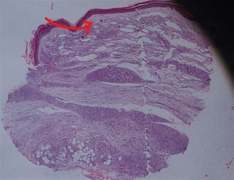 Granuloma With Lymphocyte And Epitheloid Cells Bth Above Case Download Scientific Diagram