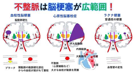 国試対策：暗記からの卒業 72話 脳卒中 Youtube