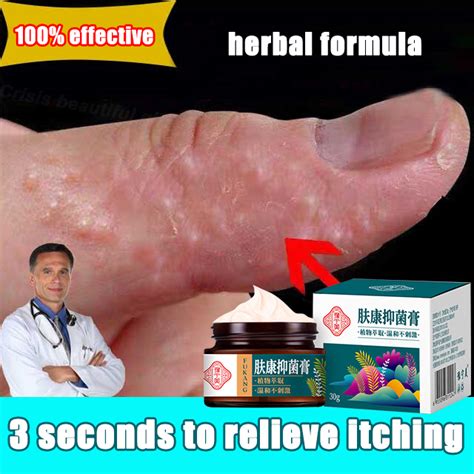 100 Effective Psoriasis Ointment Herbal Anti Itch Cream Psoriasis