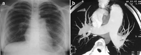 E A Postero Anterior Chest Film Of The Patient Done At Initial