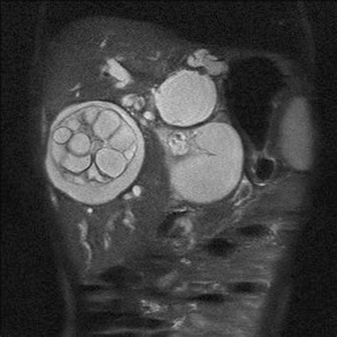 Intrabiliary Rupture Of Hydatid Cyst Demonstrated By Magnetic Resonance Cholangiopancreatography