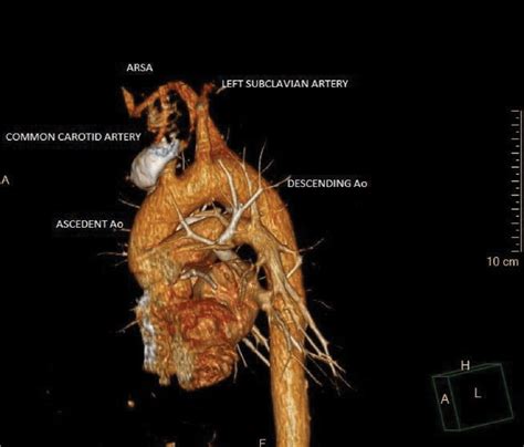 Ct Angiography Of The Aortic Arch D Reconstruction Abberant Right