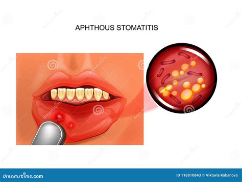 Aphthous Stomatitis Aphthae Stock Vector Illustration Of Mushroom