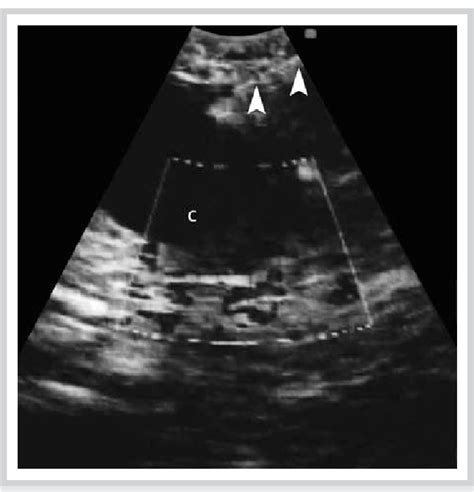 Figure 2 From Endobronchial Ultrasound Staging Of Thyroid Lesion In