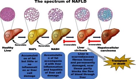 The Progression Of Nonalcoholic Fatty Liver Disease Assignment Point