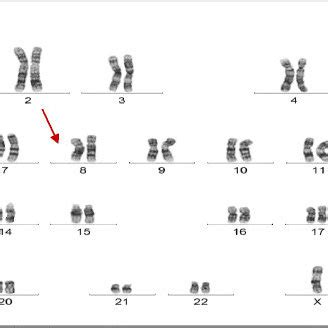 Cytogenetic Analysis G Banded Chromosomal Analysis From The Peripheral