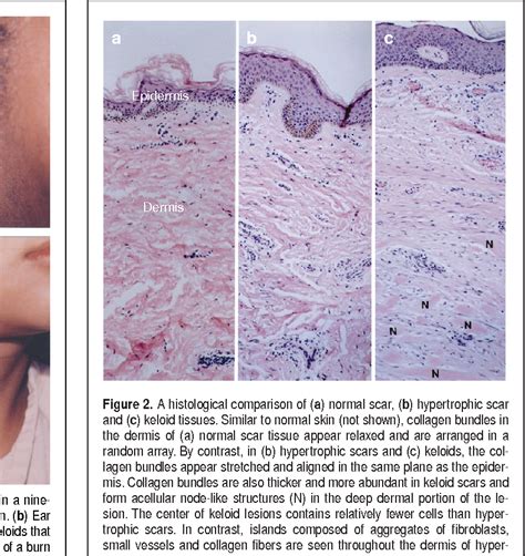 Keloid Histology