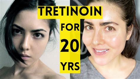 20 Year Results Of Using Tretinoin Youtube